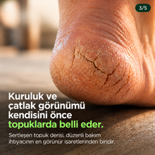 Kuru ve çatlak topuk görünümü